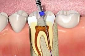 How to take care and protect teeth after root canal treatment?