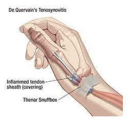 Physiotherapy treatment of rotator cuff inflammation