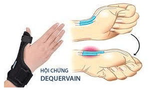 
Việc hạn chế vận động cổ tay và ngón cái sẽ có lợi cho việc điều trị viêm mỏm trâm quay
