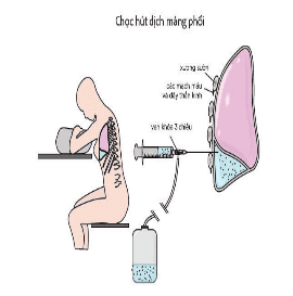 
Các bước tiến hành chọc dịch màng phổi

