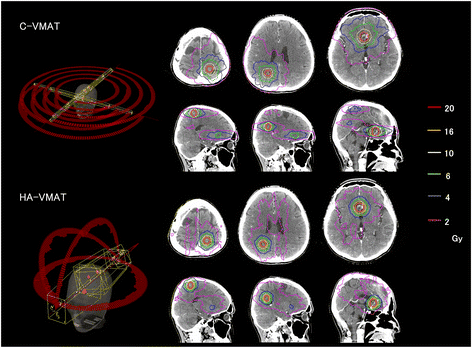 SRS radiosurgery in the treatment of central nervous system lesions