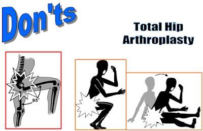 Những điều cần biết về thay khớp háng