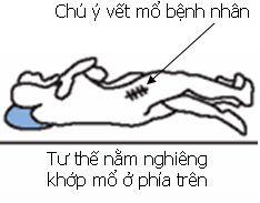 Những điều cần biết về thay khớp háng