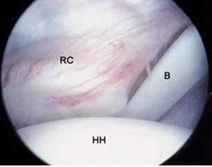 
Hình nội soi khớp vai bình thường (RC: Chóp xoay; HH: Chỏm xương cánh tay; B: Gân nhị đầu).
