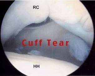 
Hình nội soi rách chóp xoay (Cuff tear: Rách chóp xoay). Khoảng trống giữa nép chóp xoay (RC) bị rách và chỏm xương cánh tay (HH).
