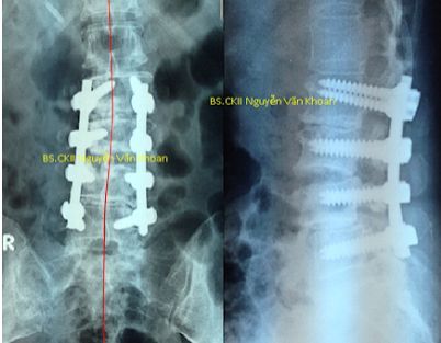 
Vẹo cột sống Syndromic phát triển thứ phát sau một số loại hội chứng
