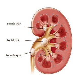 
Bệnh nhân có sỏi cần được chỉ định nội soi bàng quang gắp sỏi
