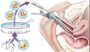 
Xét nghiệm sàng lọc di truyền trước chuyển phôi
