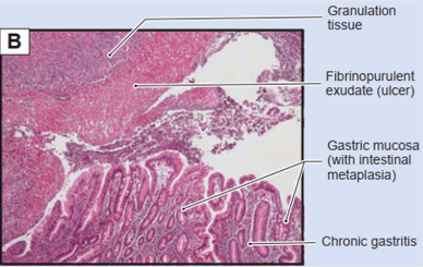 
Hình 3. Chuyển sản ruột ở viêm dạ dày mạn tính (goblet cells)
