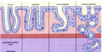 
Hình 8: Dị sản (dysplasia)
