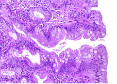 
Hình 11. Incomplete intestinal metaplasia thay thế bằng niêm mạc đại tràng gồm goblet cells không có microvillous (brush border).
