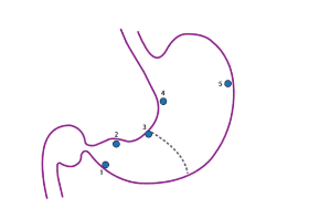 
Hình 12. Gastric mapping. Sinh thiết 5 chỗ
