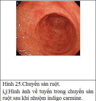 Gastric biopsy diagnoses intestinal metaplasia in the stomach