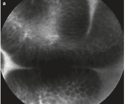 
Hình 26. Chuyển sản ruột qua confocal laser endomicroscopy. a:niêm mạc bình thường cho thấy mosaic pattern.
