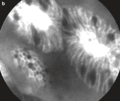 
Hình 27. Chuyển sản ruột qua confocal laser endomicroscopy. b:villous columnar-line epithelium và dark mucin trong goblet cells trong chuyển sản ruột.
