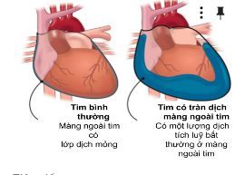 
Tim có tràn dịch màng ngoài tim khiến người bệnh khó thở
