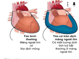 
Tim có tràn dịch màng ngoài tim khiến người bệnh khó thở
