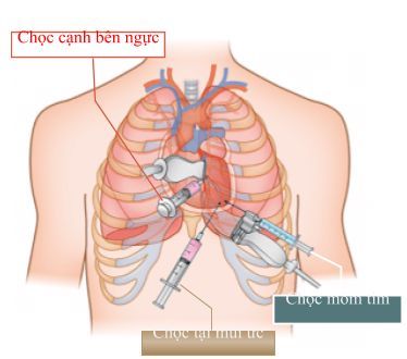 
Vị trí chọc hút dịch màng tim
