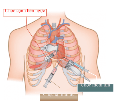 
Bác sĩ chọc hút dịch màng tim bằng cách đưa kim vào khoang màng ngoài tim và hút dịch ra ngoài
