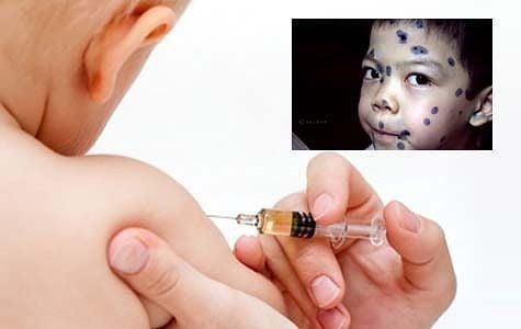 Children can be vaccinated to prevent chickenpox