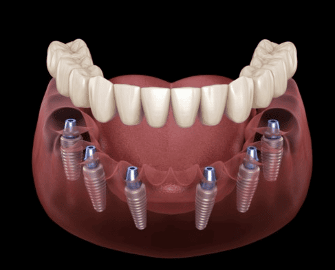 Cấy ghép Implant All On 6