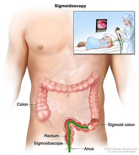 Sigma Colonoscopy