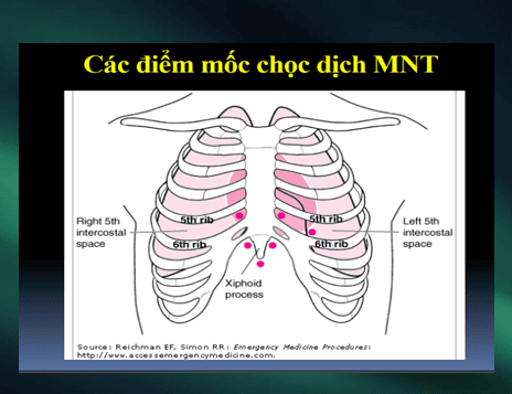 What is acute tamponade? Signs of recognition and treatment