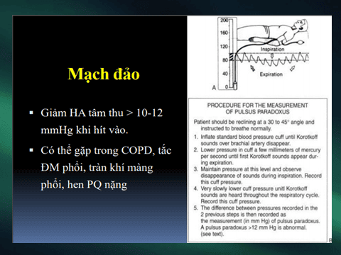 Ép tim cấp là gì? Các dấu hiệu nhận biết và điều trị