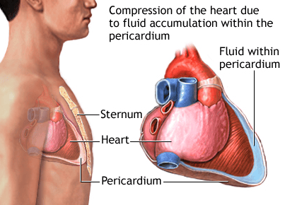 What is acute tamponade? Signs of recognition and treatment