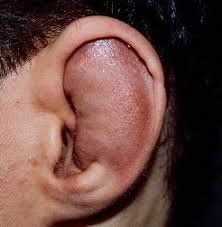 
Ear cartilage disease is an infection of the tissue that surrounds and nourishes the cartilage in the ear
