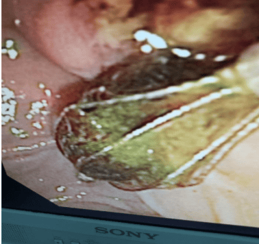 Endoscopic retrograde cholangiopancreatography - Information for patients