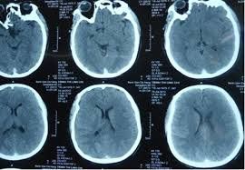 Why is it said that CT is the gold standard in diagnosing traumatic brain injury?