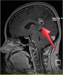 Radiation therapy for brain metastases