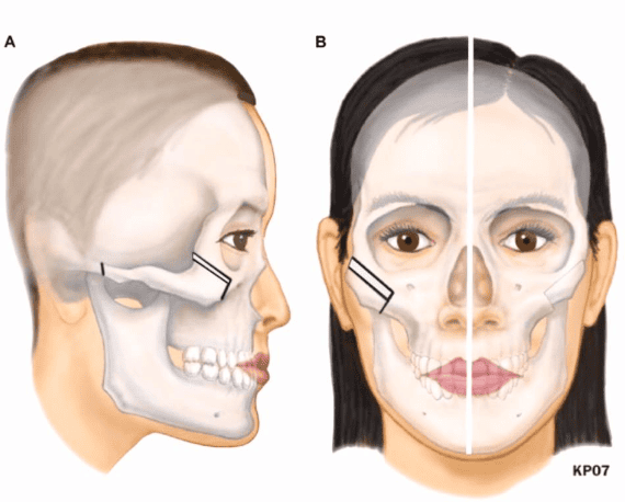 Is there any cosmetic treatment for sunken eyes and double vision after ...