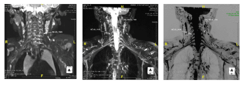 
Hình ảnh MRI đám rối thần kinh cánh tay tổn thương (hình minh họa)
