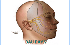 Characteristics of pain caused by neuroma V