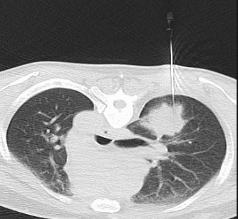 Lung/pleural biopsy under computed tomography