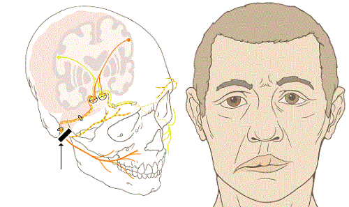 The laryngeal mask anesthesia procedure cuts the entire parotid gland, preserving the VII nerve