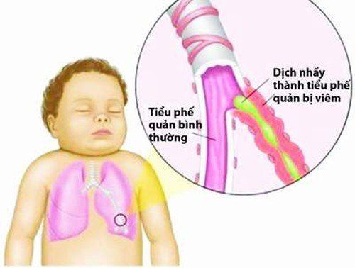 Symptoms of bronchospasm in children