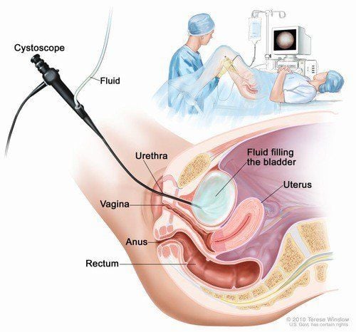 Important note for patients placed Sonde JJ