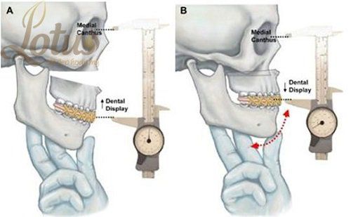 Điều trị bảo tồn không phẫu thuật gãy lồi cầu xương hàm dưới có sao không?