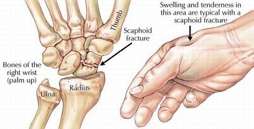 
Người bệnh bị gãy xương bàn tay sẽ gặp khó khăn trong vận động
