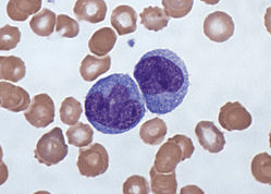 Mononucleosis in children