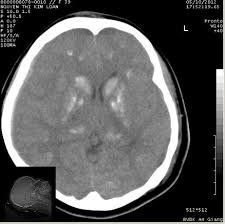 Is CT scan of the brain harmful?