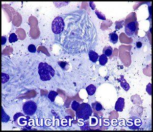 Gaucher: Rare genetic disease