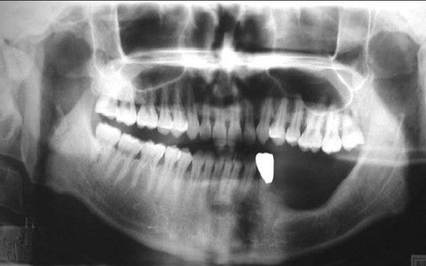 Radiation-induced osteonecrosis of the jaw