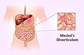 Tìm hiểu về viêm túi thừa Meckel và các biến chứng