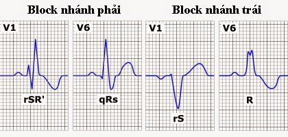 Tìm hiểu hiện tượng block nhánh trái ở tim