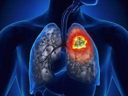 What you need to know when you have non-small cell lung cancer - Part 1