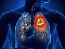 Những điều cần biết khi bạn mắc ung thư phổi không tế bào nhỏ (non-small cell lung cancer) - Phần 1